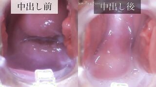 FC2-PPV-4722777 中出し前後の膣内比較クスコ動画