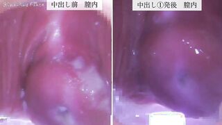 FC2-PPV-4837375 中出し後クスコ付き本編高画質版動画、3発毎中出し前後の膣内比較クスコ動画